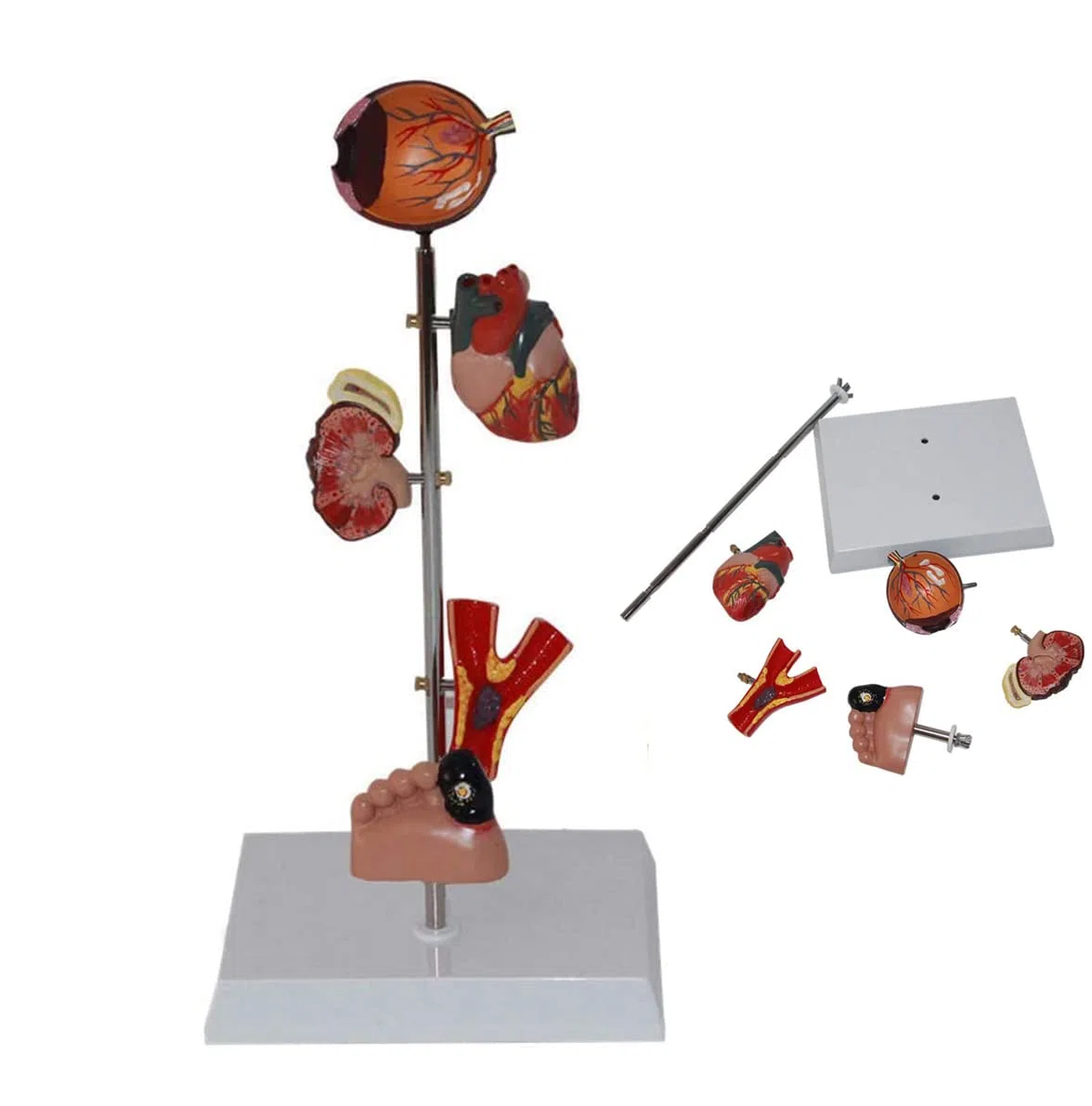 Modèle De Diabète Organ Organe Médical Anatomique Modèle De Diabète Anatomique Modèles D'anatomie Humaine pour Une Aide À La Formation Pédagogique