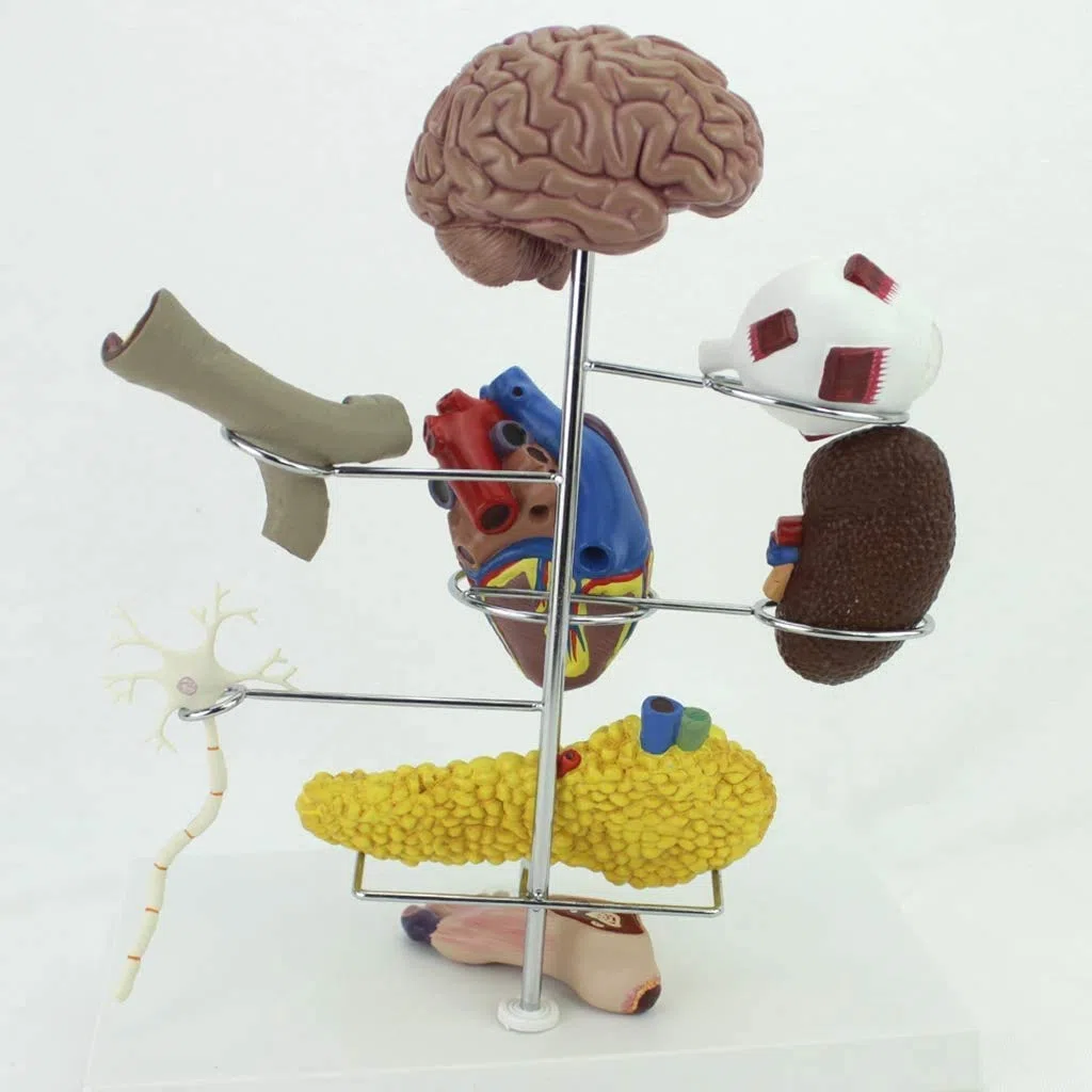 Modèle D'Organes Diabète - Médical Anatomical Cérébrale Diabète Complication Cardiaque Chirurgie du Pancréas Neuron - pour Aide À La Formation Pédagogique des Étudiants