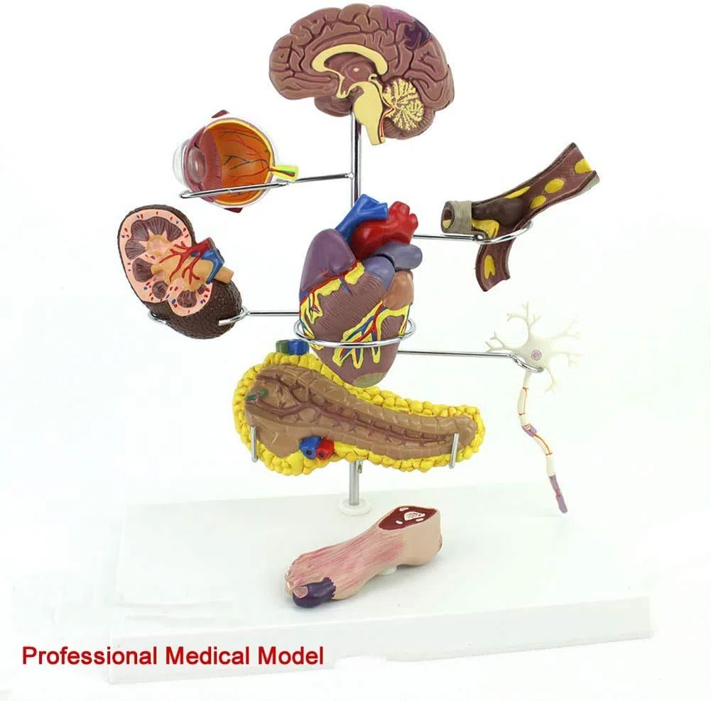 Diabète Enseignement Médical Modèle D'Affichage Sciences De L'Éducation Pathologie Expliquer Une Bonne Aide