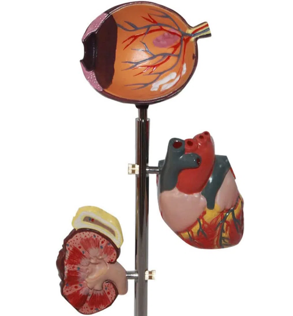 Modèle De Diabète Organ Organe Médical Anatomique Modèle De Diabète Anatomique Modèles D'anatomie Humaine pour Une Aide À La Formation Pédagogique