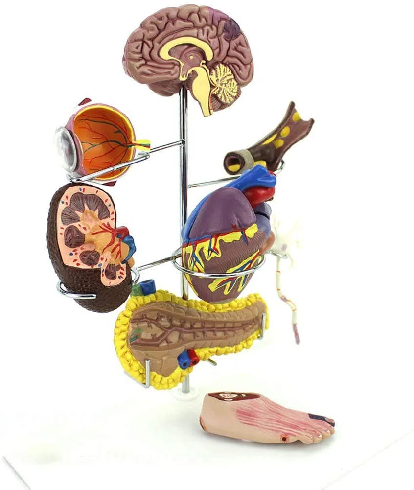 Diabète Enseignement Médical Modèle D'Affichage Sciences De L'Éducation Pathologie Expliquer Une Bonne Aide