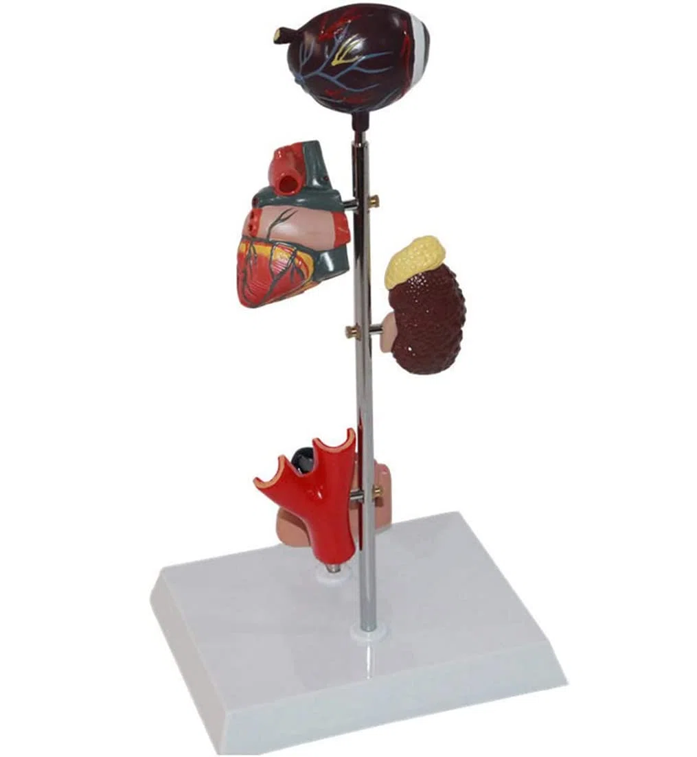 Modèle De Diabète Organ Organe Médical Anatomique Modèle De Diabète Anatomique Modèles D'anatomie Humaine pour Une Aide À La Formation Pédagogique