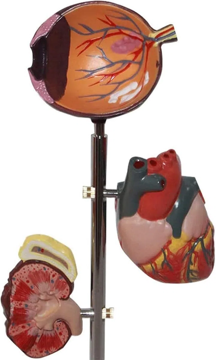 Modèle D'organe du Diabète - Anatomie Médicale Modèle du Diabète - Modèle Scientifique D'anatomie Amovible - pour L'éducation Médicale Et La Formation