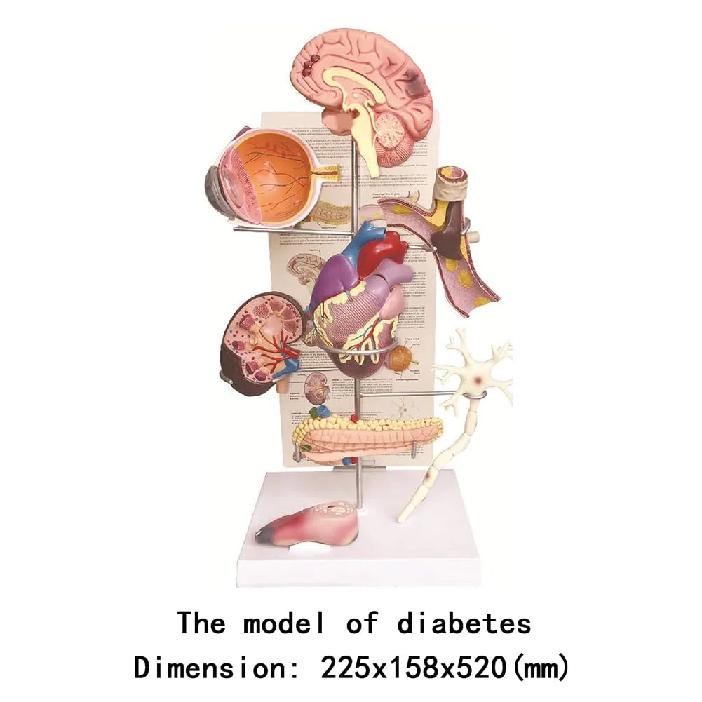 Modèle de Diabète Humain, Modèle de Diabète Anatomique, Modèle d'organe de Diabétique Matériau en PVC, Modèle d'affichage des Complications du Diabète pour L'hôpital