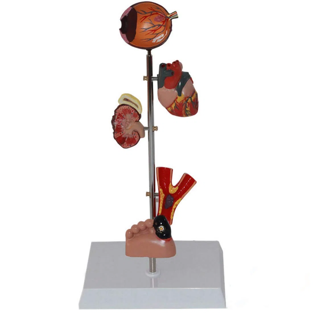 ERNZI Modèle Éducatif Modèle Organe De Diabète - Modèle Médical Anatomique De Diabète - Modèle Anatomique Organe Amovible Modèles Scientifiques Anatomie Humaine - pour Aide À La Formation