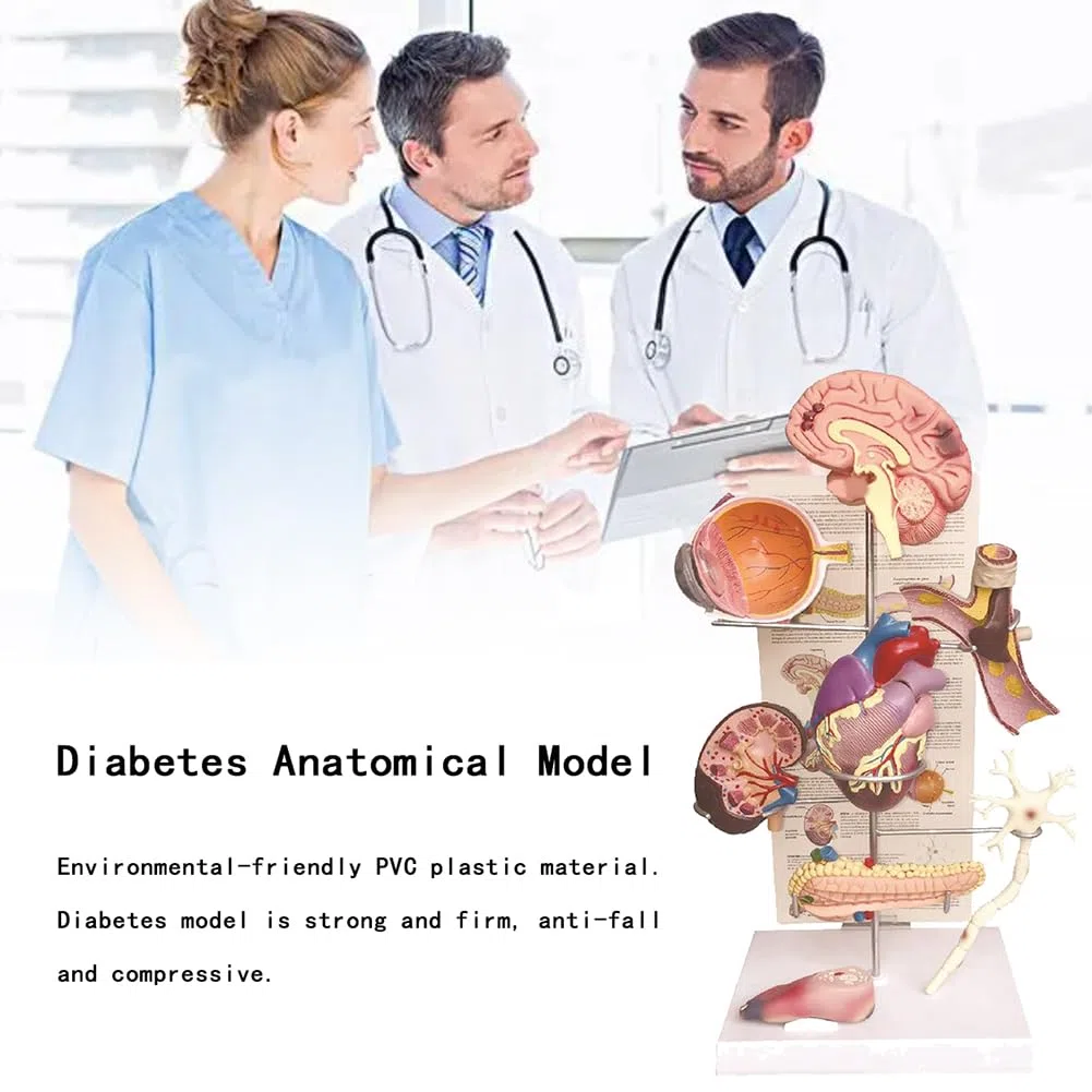 Modèle de Diabète Humain, Modèle de Diabète Anatomique, Modèle d'organe de Diabétique Matériau en PVC, Modèle d'affichage des Complications du Diabète pour L'hôpital