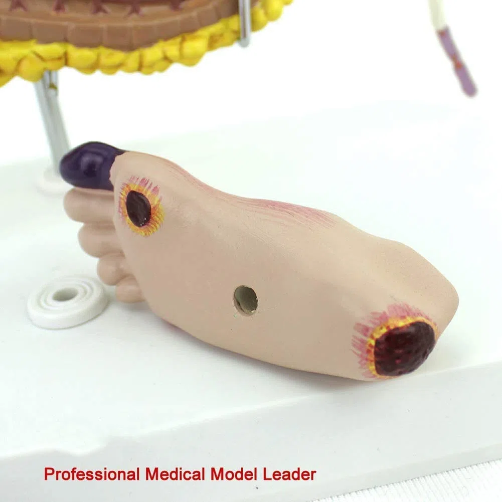 Diabète Enseignement Médical Modèle D'Affichage Sciences De L'Éducation Pathologie Expliquer Une Bonne Aide
