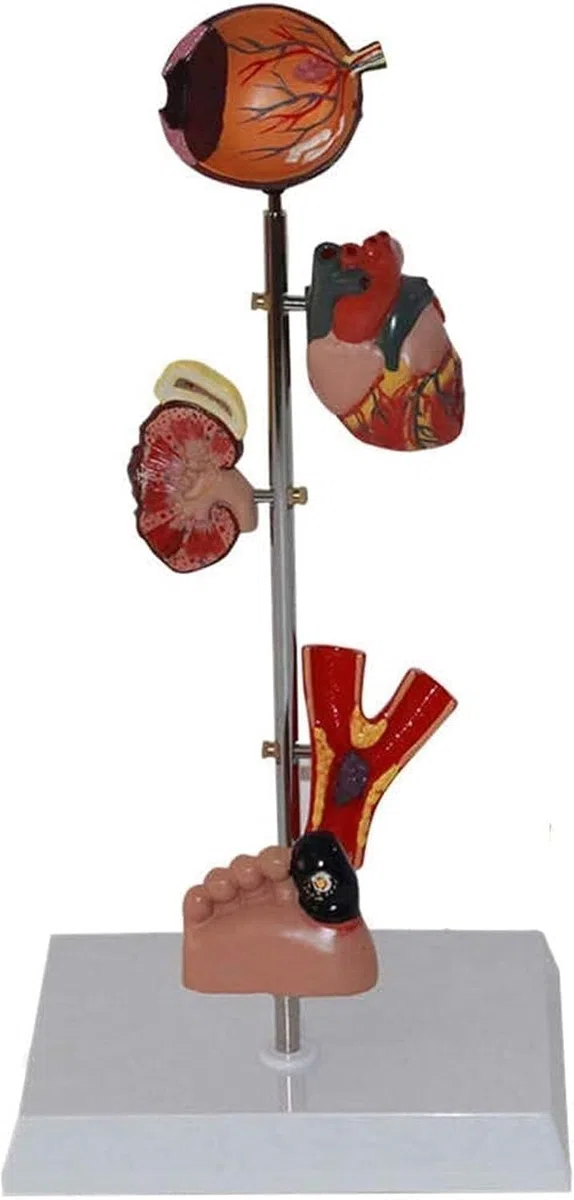Modèle D'organe du Diabète - Anatomie Médicale Modèle du Diabète - Modèle Scientifique D'anatomie Amovible - pour L'éducation Médicale Et La Formation