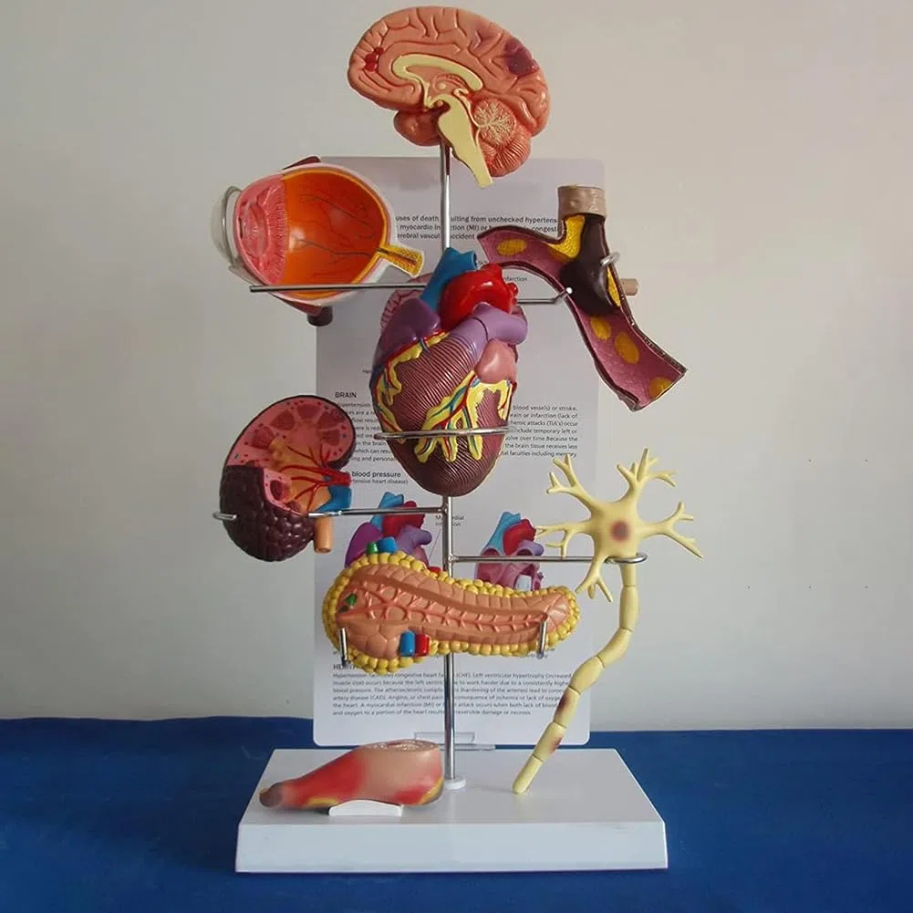 Modèle de Diabète Humain, Modèle de Diabète Anatomique, Modèle d'organe de Diabétique Matériau en PVC, Modèle d'affichage des Complications du Diabète pour L'hôpital