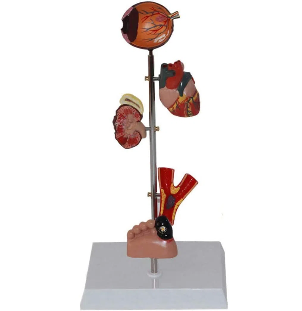 Modèle De Diabète Organ Organe Médical Anatomique Modèle De Diabète Anatomique Modèles D'anatomie Humaine pour Une Aide À La Formation Pédagogique
