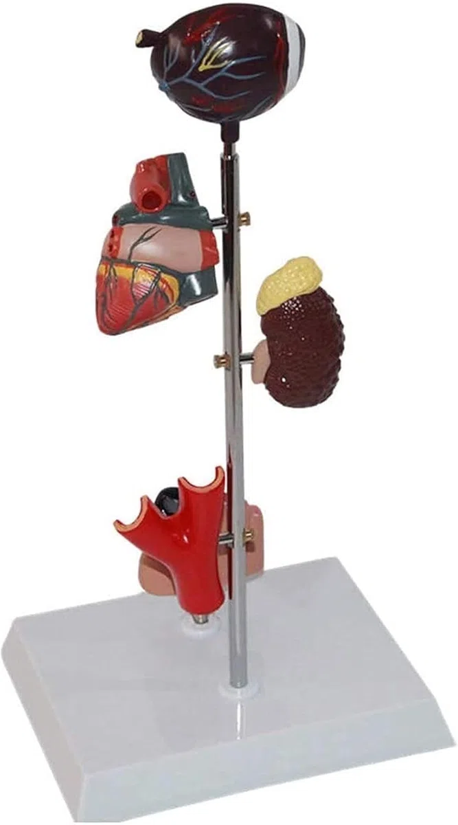 Modèle D'organe du Diabète - Anatomie Médicale Modèle du Diabète - Modèle Scientifique D'anatomie Amovible - pour L'éducation Médicale Et La Formation
