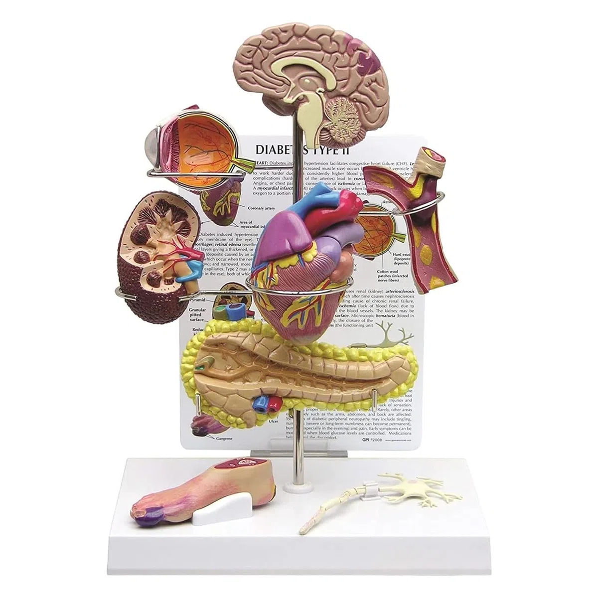 Modèle de Diabète Humain, Modèle de Diabète Anatomique, Modèle d'organe de Diabétique Matériau en PVC, Modèle d'affichage des Complications du Diabète pour L'hôpital