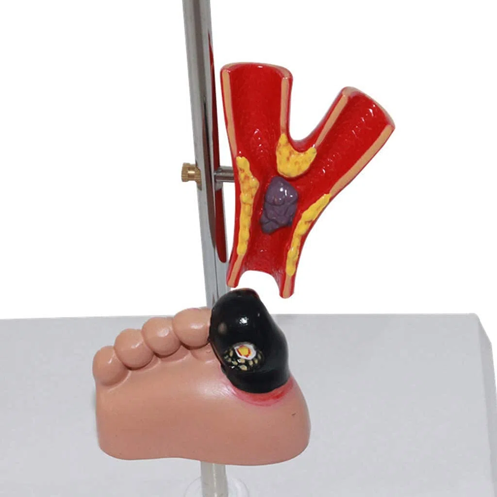 Modèle De Diabète Organ Organe Médical Anatomique Modèle De Diabète Anatomique Modèles D'anatomie Humaine pour Une Aide À La Formation Pédagogique