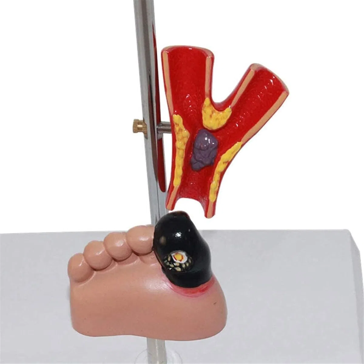 Modèle D'organe du Diabète - Anatomie Médicale Modèle du Diabète - Modèle Scientifique D'anatomie Amovible - pour L'éducation Médicale Et La Formation