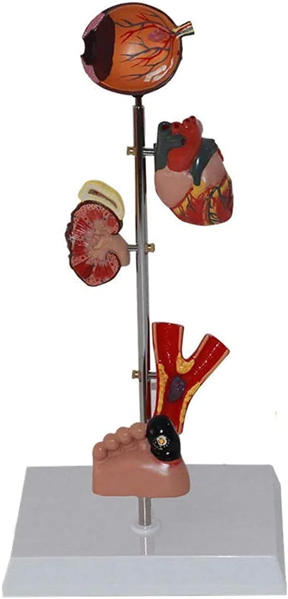 Modèle d'organe du diabète - Modèle Anatomique médical du diabète - Modèle Anatomique d'organe Humain Amovible Modèles scientifiques d'anatomie Humaine - Compatible avec Les programmes éducatifs médi