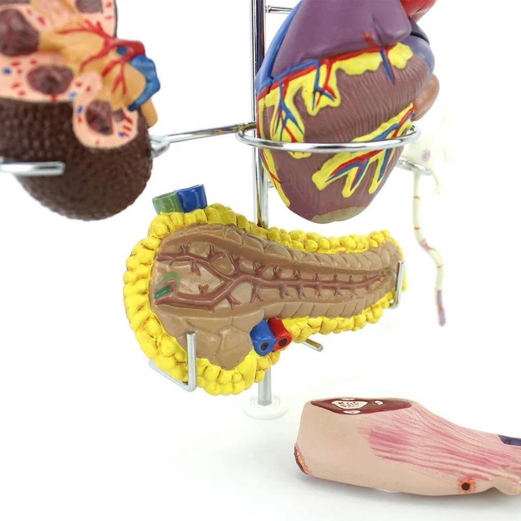 Modèle D'Organes Diabète - Médical Anatomical Cérébrale Diabète Complication Cardiaque Chirurgie du Pancréas Neuron - pour Aide À La Formation Pédagogique des Étudiants